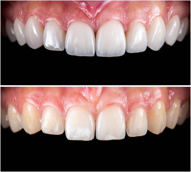 veneers root canal crown root canal dermal fillers botox deep cleanning srp braces extraction tooth extract pulled out partial dentures removable root canal dentures composite resin inlay onlay bridge crowns Invisalign clear aligners teeth reshaping gummy smile botox bonding teeth whitening miami best dentist straight teeth white teeth perfect teeth beautiful smile veneers smile design veneers