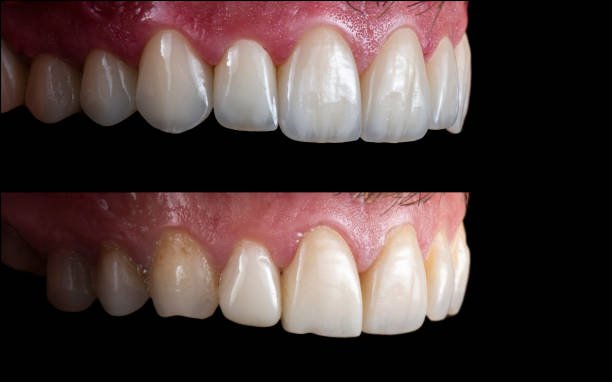 veneers root canal crown root canal dermal fillers botox deep cleanning srp braces extraction tooth extract pulled out partial dentures removable root canal dentures composite resin inlay onlay bridge crowns Invisalign clear aligners teeth reshaping gummy smile botox bonding teeth whitening miami best dentist straight teeth white teeth perfect teeth beautiful smile veneers smile design veneers