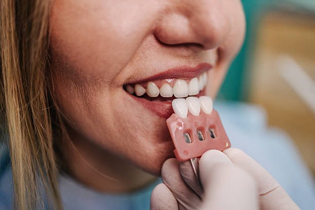 veneers root canal crown root canal dermal fillers botox deep cleanning srp braces extraction tooth extract pulled out partial dentures removable root canal dentures composite resin inlay onlay bridge crowns Invisalign clear aligners teeth reshaping gummy smile botox bonding teeth whitening miami best dentist straight teeth white teeth perfect teeth beautiful smile veneers smile design veneers