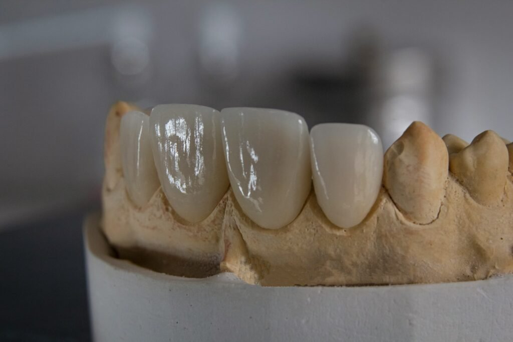 Miami best veneers, cheap good veneers Miami. Veneers results Miami