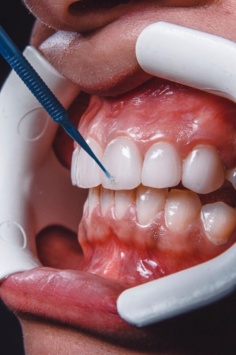 Miami best veneers, cheap good veneers Miami