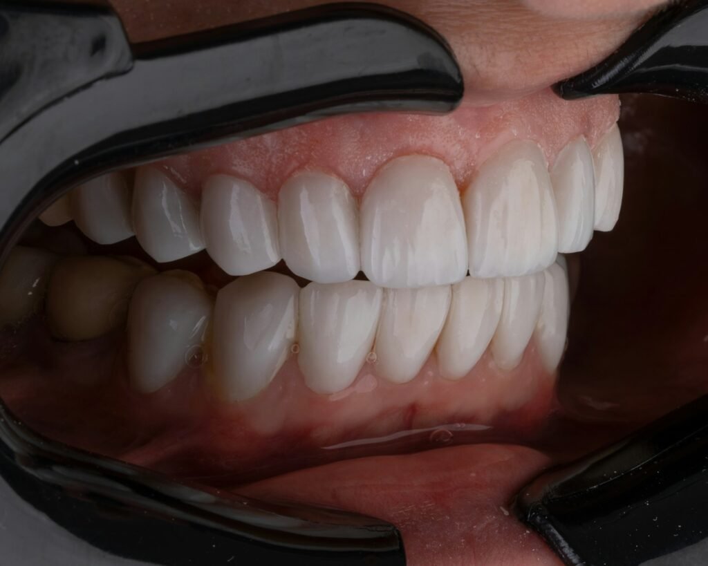 veneers smile miami best dentist cheap smile design composite veneers white teeth miami