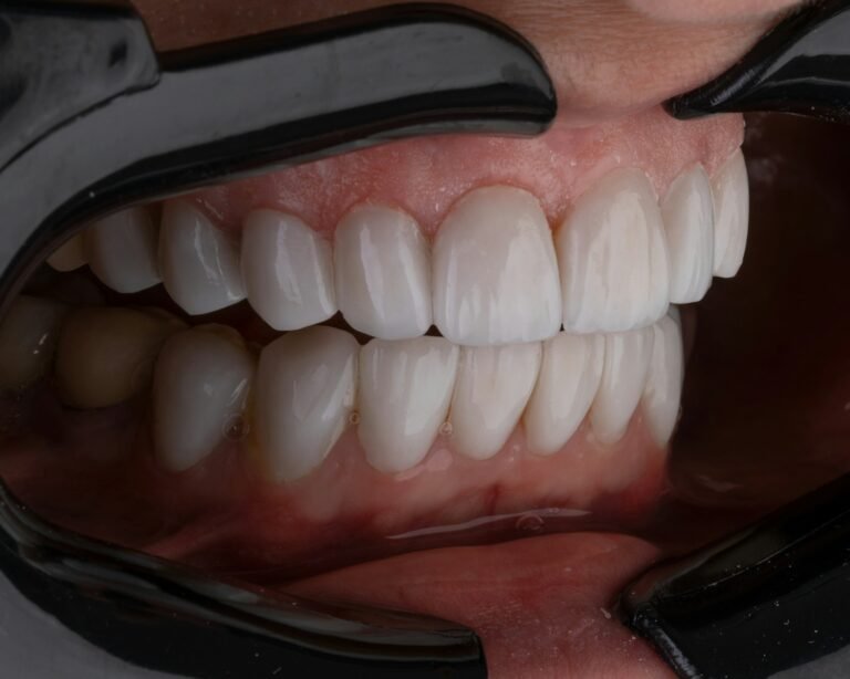 veneers smile miami best dentist cheap smile design composite veneers white teeth miami