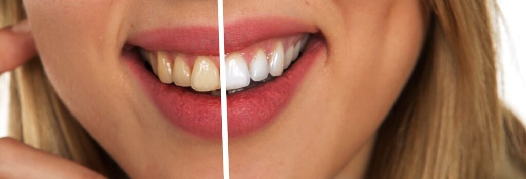 teeth whitening miami best dentist straight teeth white teeth perfect teeth beautiful smile veneers