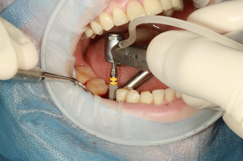 teeth whitening miami best dentist straight teeth white teeth perfect teeth beautiful smile veneers implant all on x