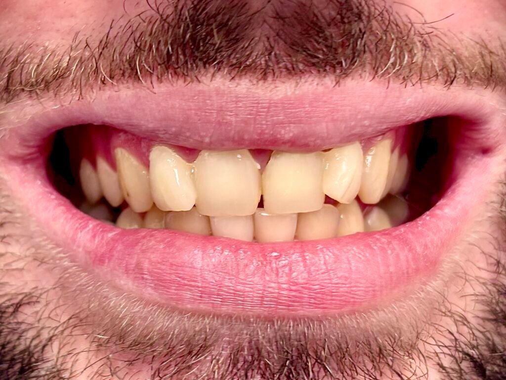 smile miami design veneers white teeth best dentist natural results