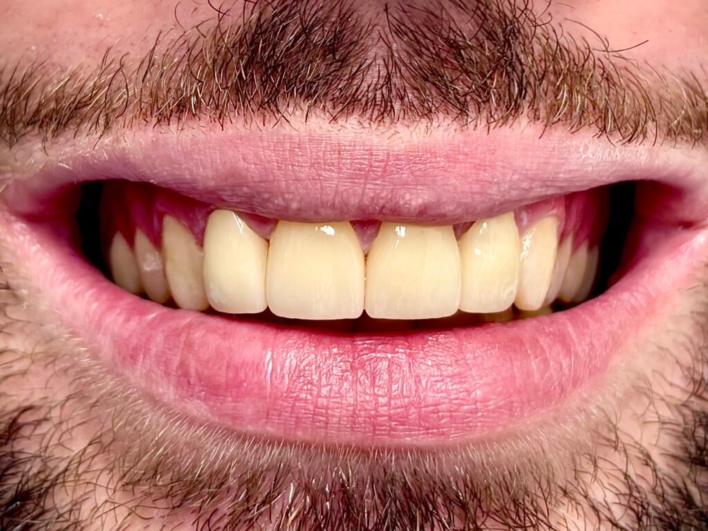 smile miami design veneers white teeth best dentist natural results