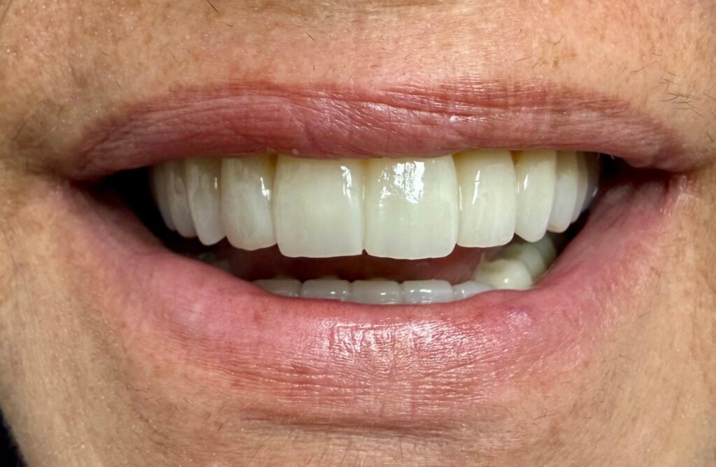smile miami design veneers white teeth best dentist natural results