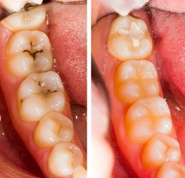composite fillings  teeth whitening miami best dentist straight teeth white teeth perfect teeth beautiful smile veneers smile design veneers