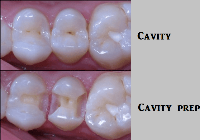 composite fillings teeth whitening miami best dentist straight teeth white teeth perfect teeth beautiful smile veneers smile design veneers
