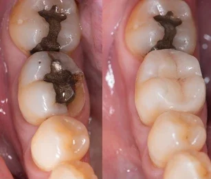 composite fillings teeth whitening miami best dentist straight teeth white teeth perfect teeth beautiful smile veneers smile design veneers
