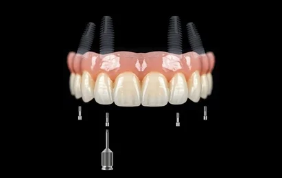 bridge teeth whitening miami best dentist straight teeth white teeth perfect teeth beautiful smile veneers implant all on x