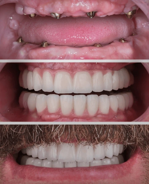bridge teeth whitening miami best dentist straight teeth white teeth perfect teeth beautiful smile veneers implant all on x