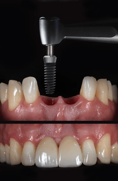 bridge teeth whitening miami best dentist straight teeth white teeth perfect teeth beautiful smile veneers implant all on x