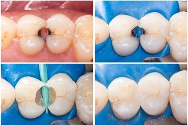 composite fillings  teeth whitening miami best dentist straight teeth white teeth perfect teeth beautiful smile veneers smile design veneers