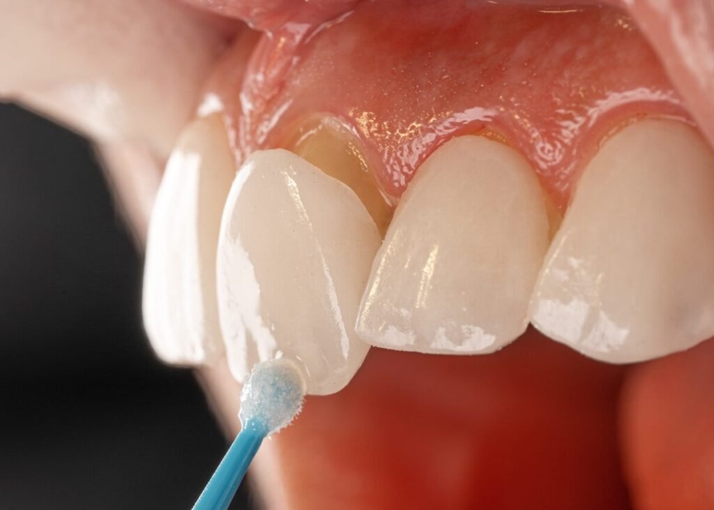 miami veneer best dentist teeth natural white teeth smile