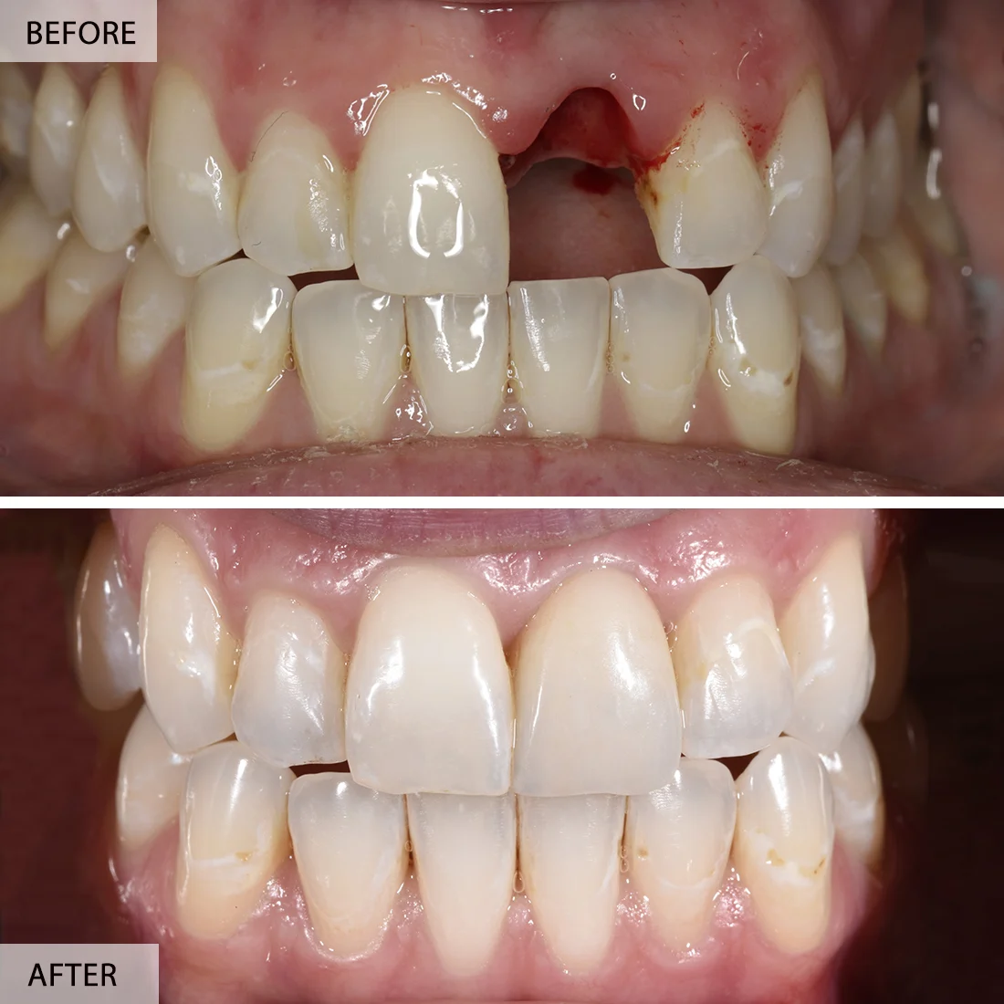 bridge teeth whitening miami best dentist straight teeth white teeth perfect teeth beautiful smile veneers implant all on x