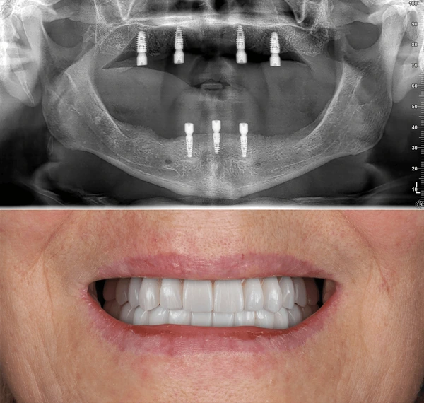 bridge teeth whitening miami best dentist straight teeth white teeth perfect teeth beautiful smile veneers implant all on x