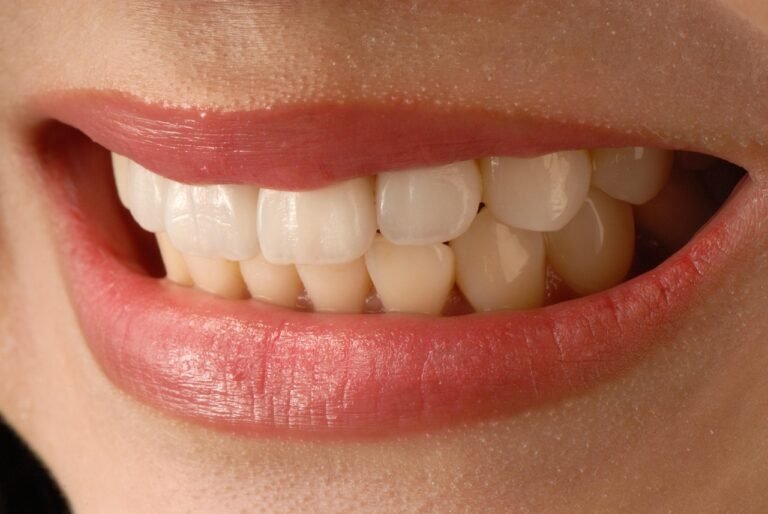 miami best veneers dentist white teeth smile design Hollywood smile