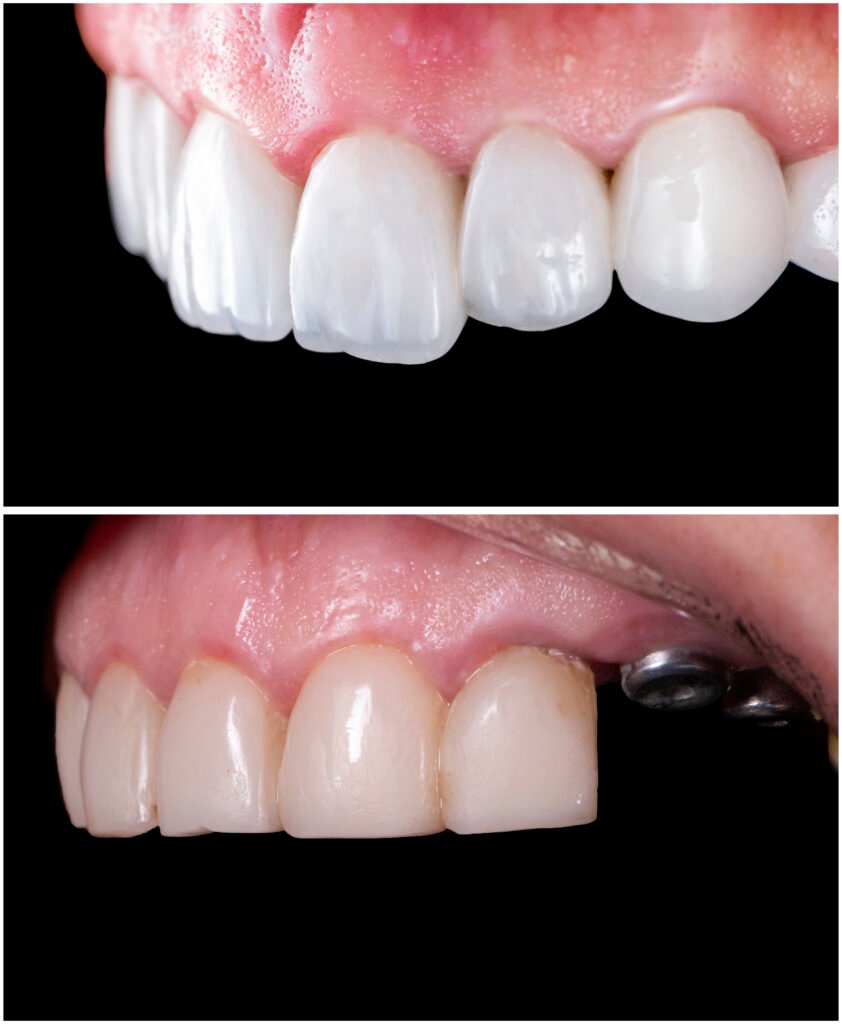 teeth whitening miami best dentist straight teeth white teeth perfect teeth beautiful smile veneers implant all on x