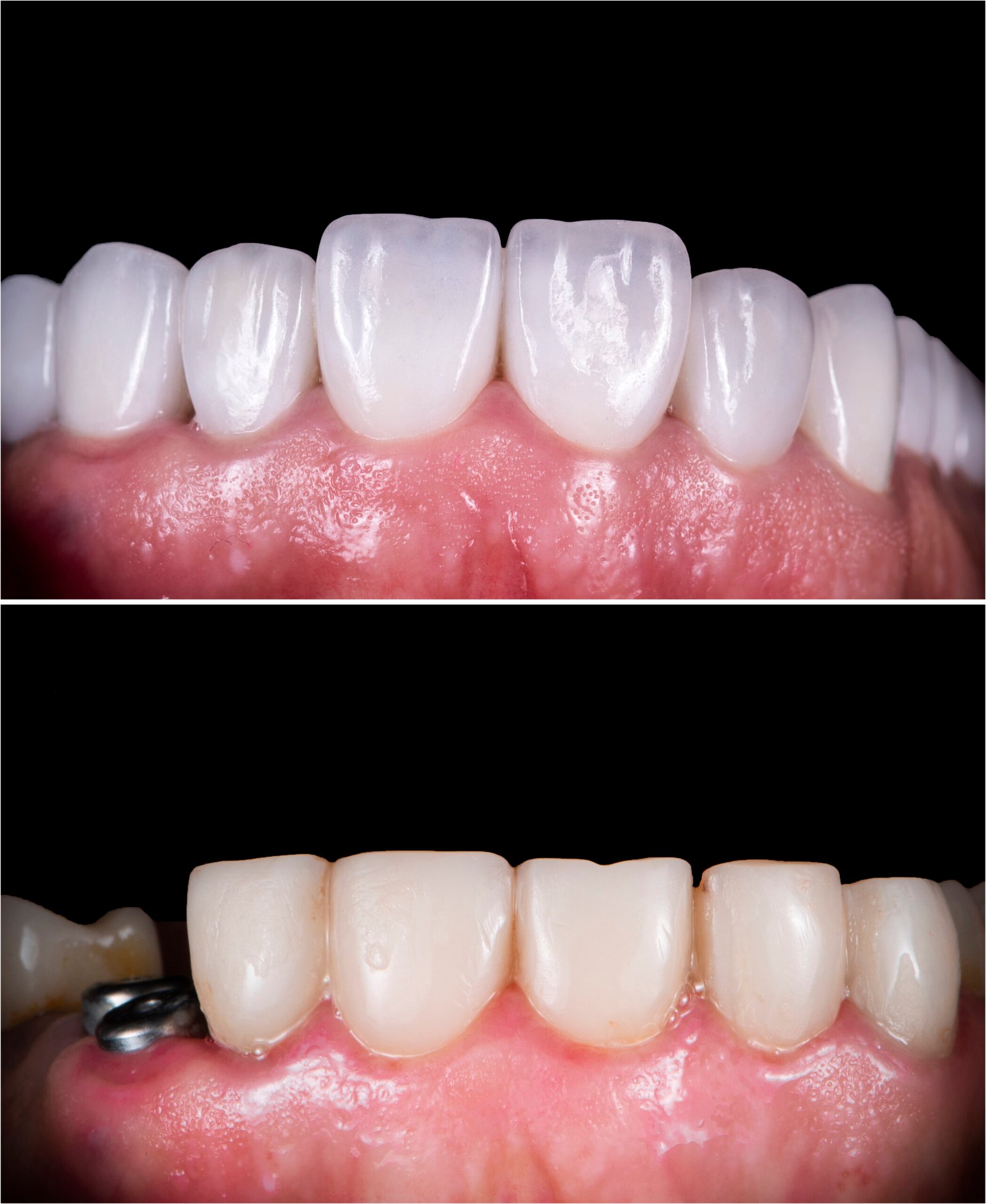 teeth whitening miami best dentist straight teeth white teeth perfect teeth beautiful smile veneers implant all on x