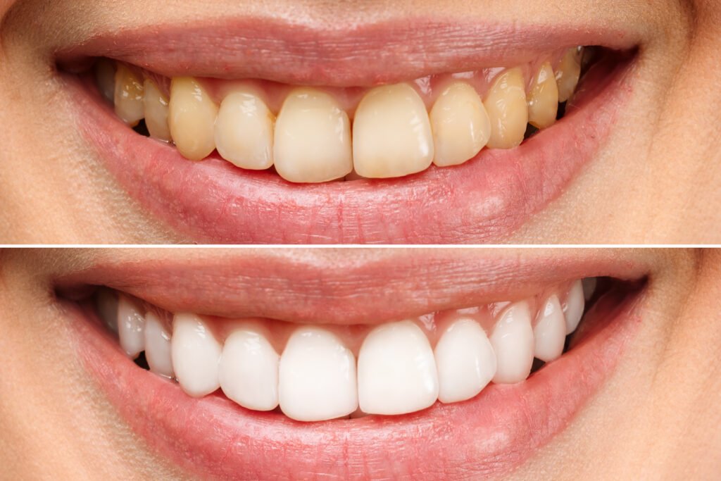 teeth whitening miami best dentist straight teeth white teeth perfect teeth beautiful smile veneers