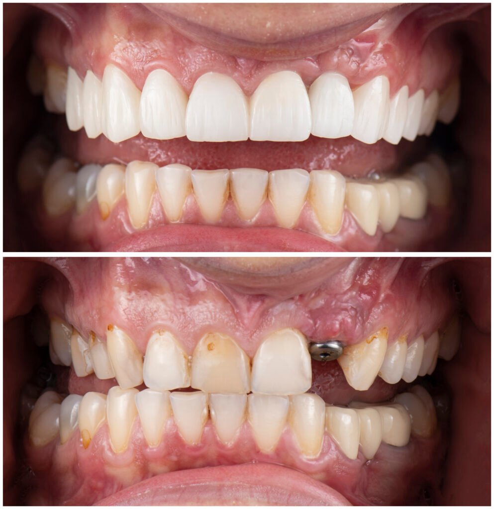 teeth whitening miami best dentist straight teeth white teeth perfect teeth beautiful smile veneers implant all on x