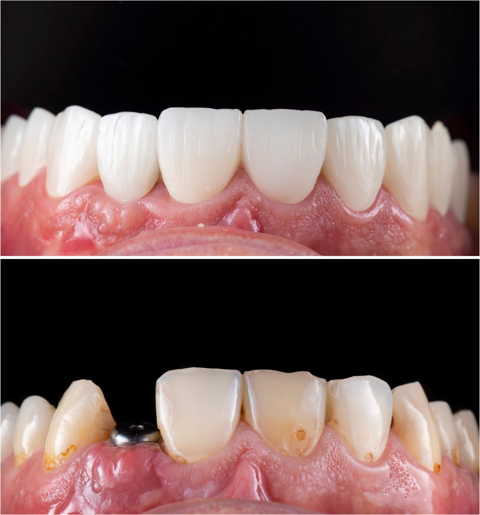 teeth whitening miami best dentist straight teeth white teeth perfect teeth beautiful smile veneers implant all on x