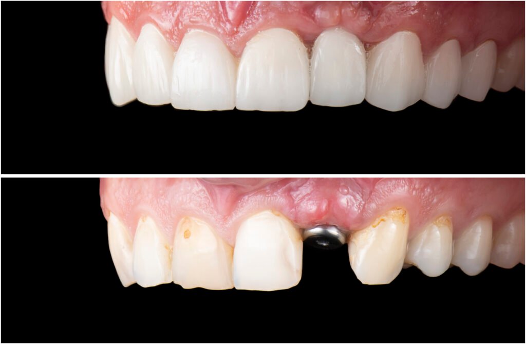 teeth whitening miami best dentist straight teeth white teeth perfect teeth beautiful smile veneers implant all on x