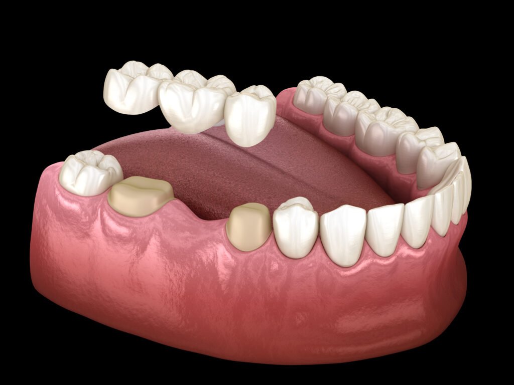 bridge teeth whitening miami best dentist straight teeth white teeth perfect teeth beautiful smile veneers implant all on x