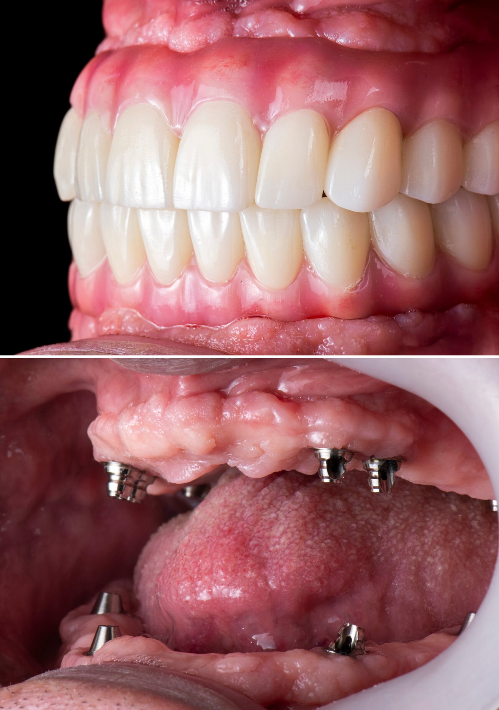 bridge teeth whitening miami best dentist straight teeth white teeth perfect teeth beautiful smile veneers implant all on x