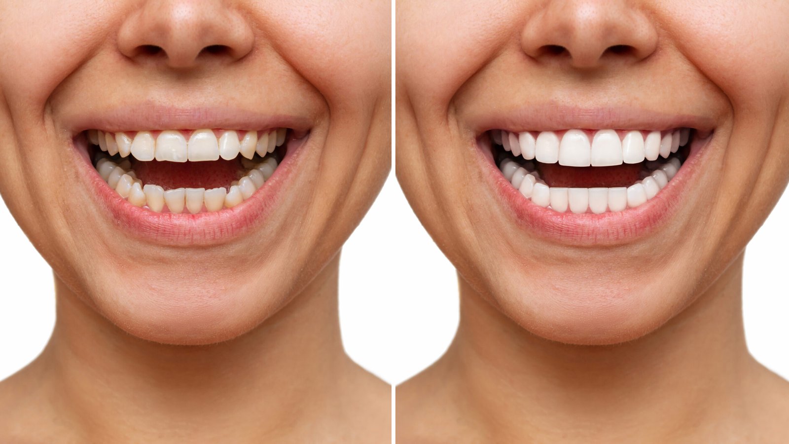 teeth whitening miami best dentist straight teeth white teeth perfect teeth beautiful smile veneers