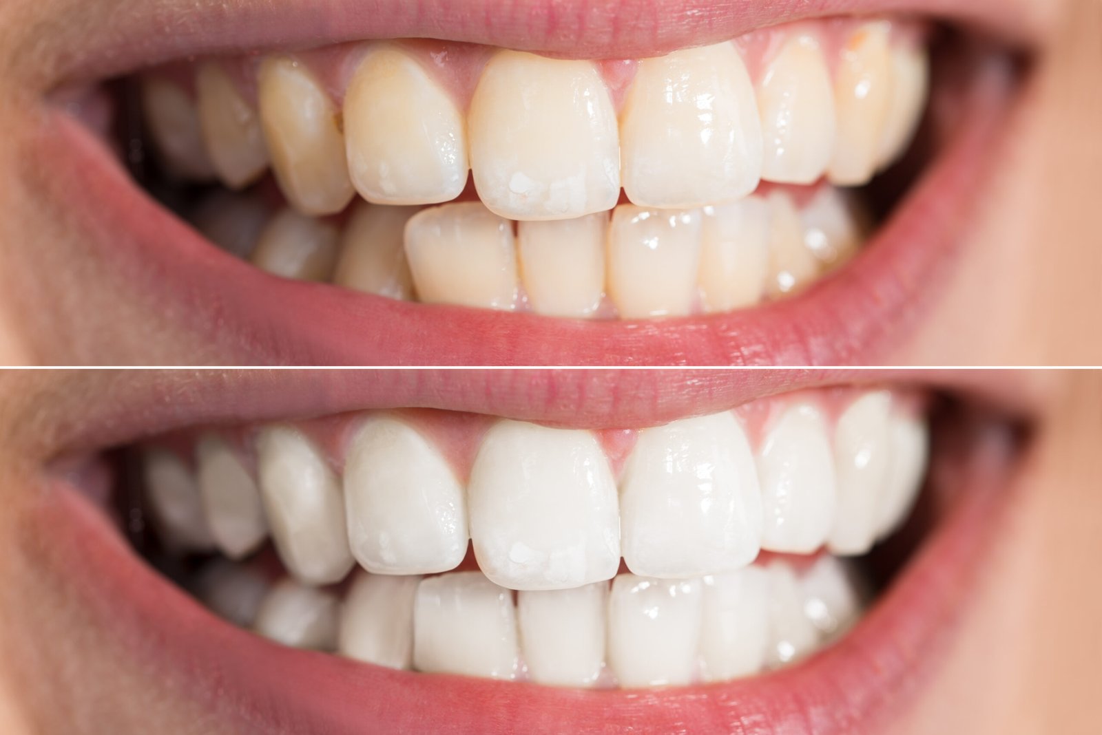 teeth whitening miami best dentist straight teeth white teeth perfect teeth beautiful smile veneers
