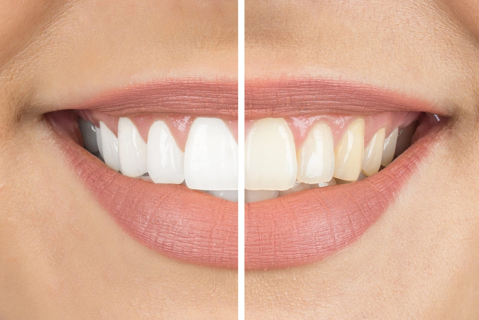 teeth whitening miami best dentist straight teeth white teeth perfect teeth beautiful smile veneers