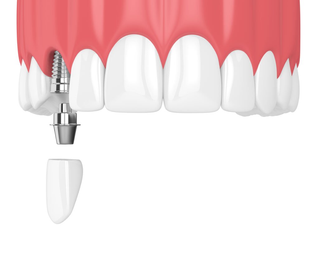 teeth whitening miami best dentist straight teeth white teeth perfect teeth beautiful smile veneers implant all on x