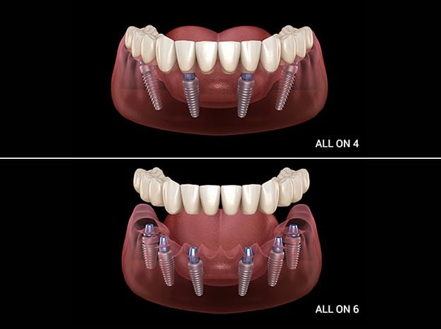 bridge teeth whitening miami best dentist straight teeth white teeth perfect teeth beautiful smile veneers implant all on x