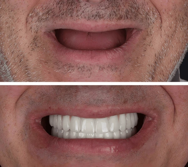 bridge teeth whitening miami best dentist straight teeth white teeth perfect teeth beautiful smile veneers implant all on x