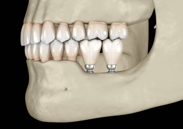 bridge teeth whitening miami best dentist straight teeth white teeth perfect teeth beautiful smile veneers implant all on x