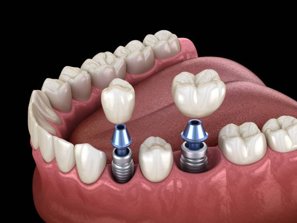 teeth whitening miami best dentist straight teeth white teeth perfect teeth beautiful smile veneers implant all on x