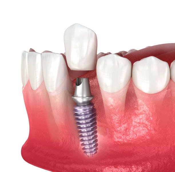 teeth whitening miami best dentist straight teeth white teeth perfect teeth beautiful smile veneers implant all on x