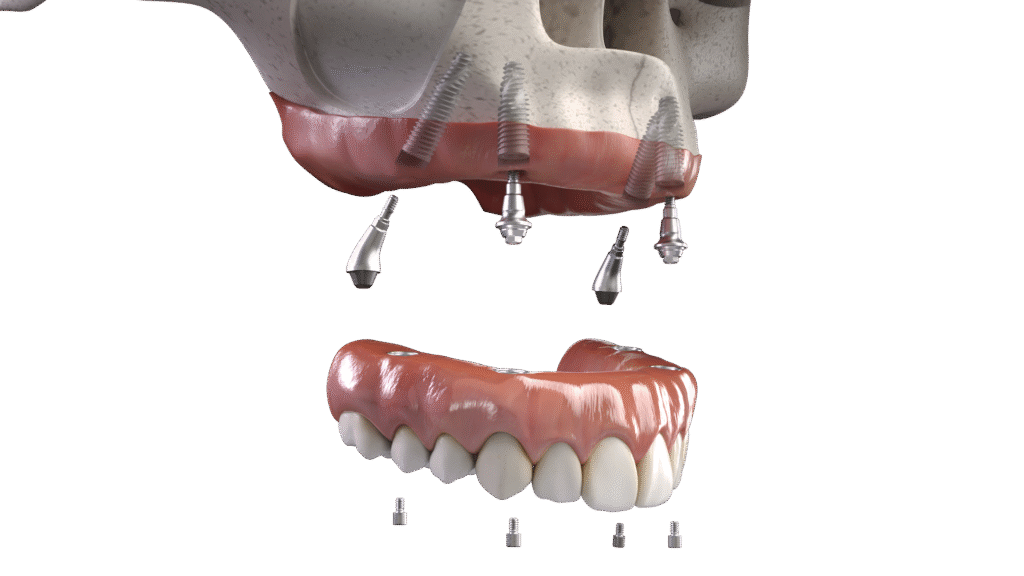 bridge teeth whitening miami best dentist straight teeth white teeth perfect teeth beautiful smile veneers implant all on x