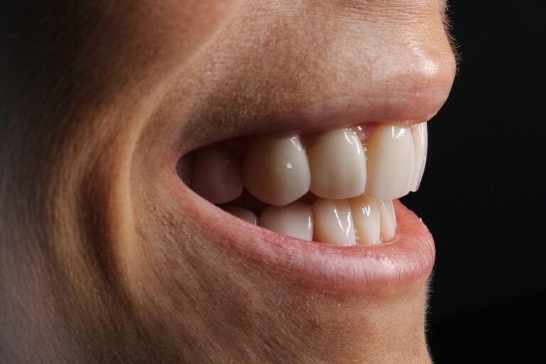 veneers smile miami best dentist cheap smile design composite veneers white teeth miami