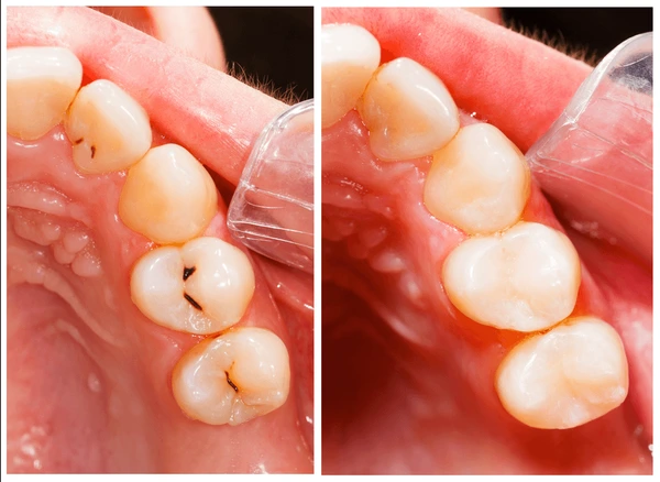 composite fillings  teeth whitening miami best dentist straight teeth white teeth perfect teeth beautiful smile veneers smile design veneers