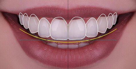 teeth reshaping gummy smile botox bonding teeth whitening miami best dentist straight teeth white teeth perfect teeth beautiful smile veneers smile design veneers