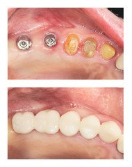 bridge crowns Invisalign clear aligners teeth reshaping gummy smile botox bonding teeth whitening miami best dentist straight teeth white teeth perfect teeth beautiful smile veneers smile design veneers