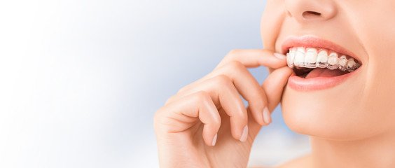 Invisalign clear aligners teeth reshaping gummy smile botox bonding teeth whitening miami best dentist straight teeth white teeth perfect teeth beautiful smile veneers smile design veneers