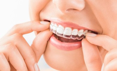 Invisalign clear aligners teeth reshaping gummy smile botox bonding teeth whitening miami best dentist straight teeth white teeth perfect teeth beautiful smile veneers smile design veneers
