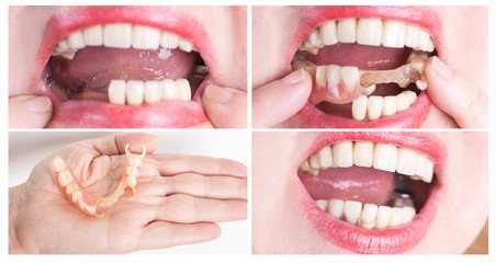 bridge crowns Invisalign clear aligners teeth reshaping gummy smile botox bonding teeth whitening miami best dentist straight teeth white teeth perfect teeth beautiful smile veneers smile design veneers