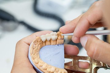 bridge crowns Invisalign clear aligners teeth reshaping gummy smile botox bonding teeth whitening miami best dentist straight teeth white teeth perfect teeth beautiful smile veneers smile design veneers