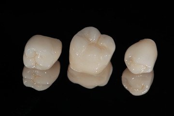 crowns Invisalign clear aligners teeth reshaping gummy smile botox bonding teeth whitening miami best dentist straight teeth white teeth perfect teeth beautiful smile veneers smile design veneers